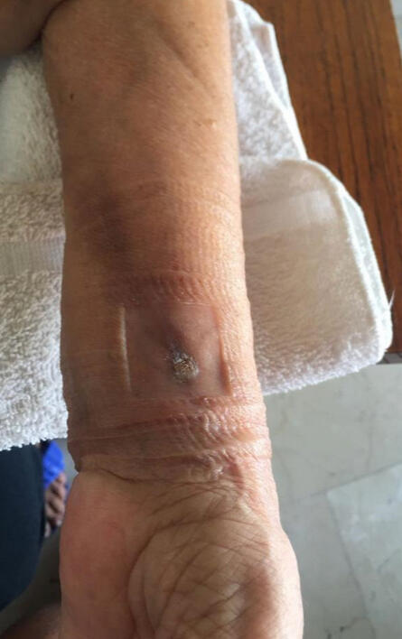 5 semanas de tratamiento