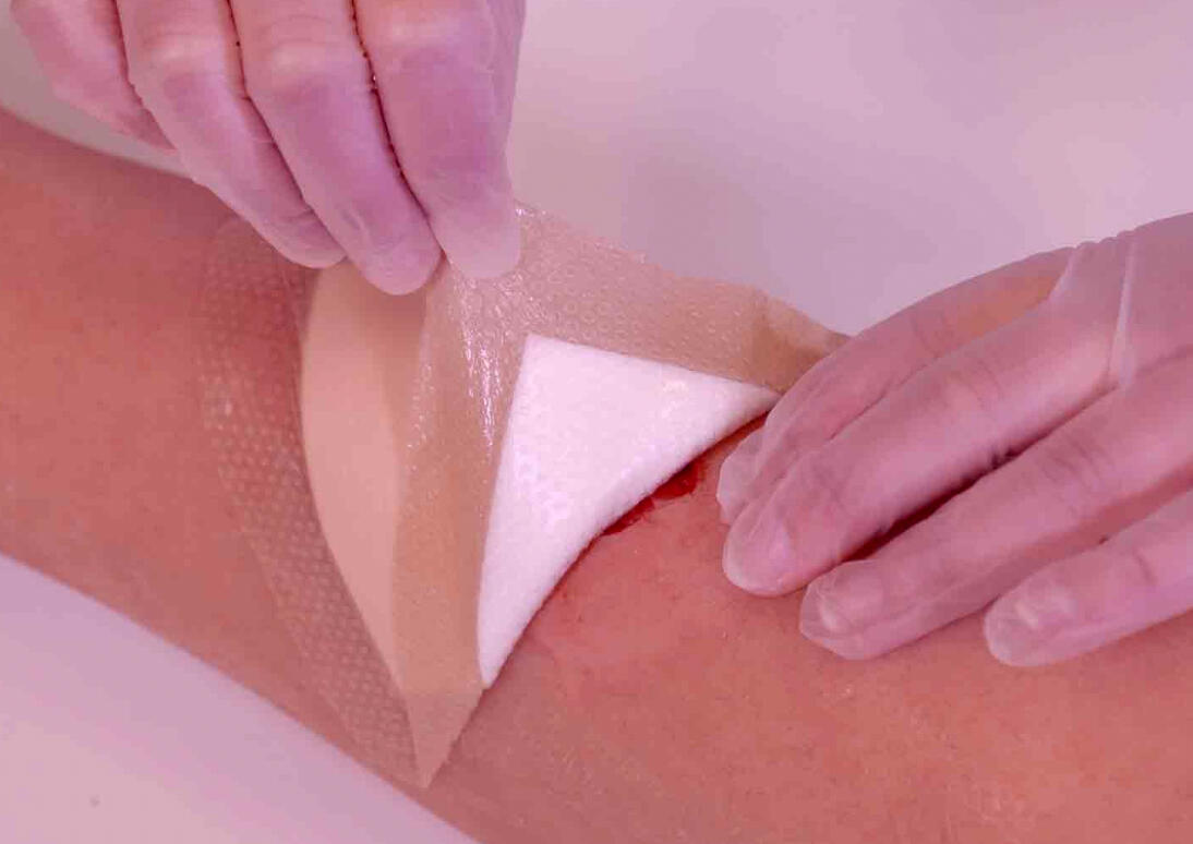 Colocación de apósitos avanzados