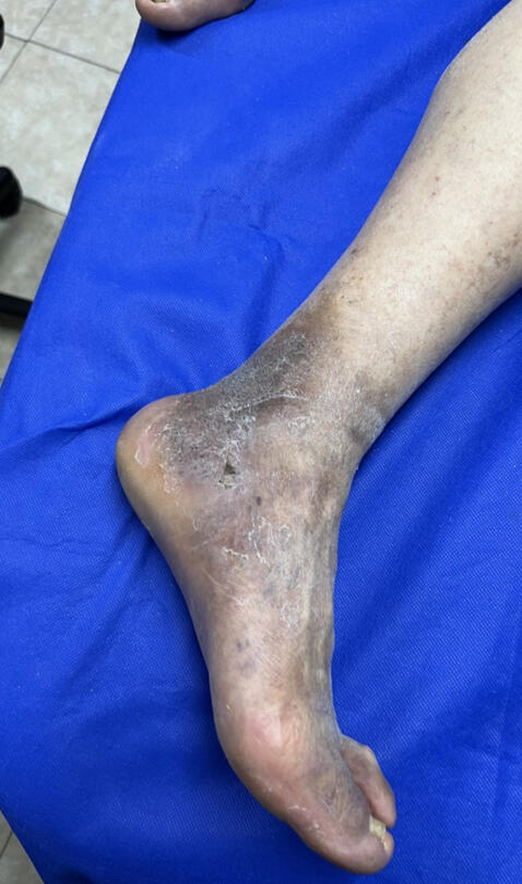 10 semanas de tratamiento